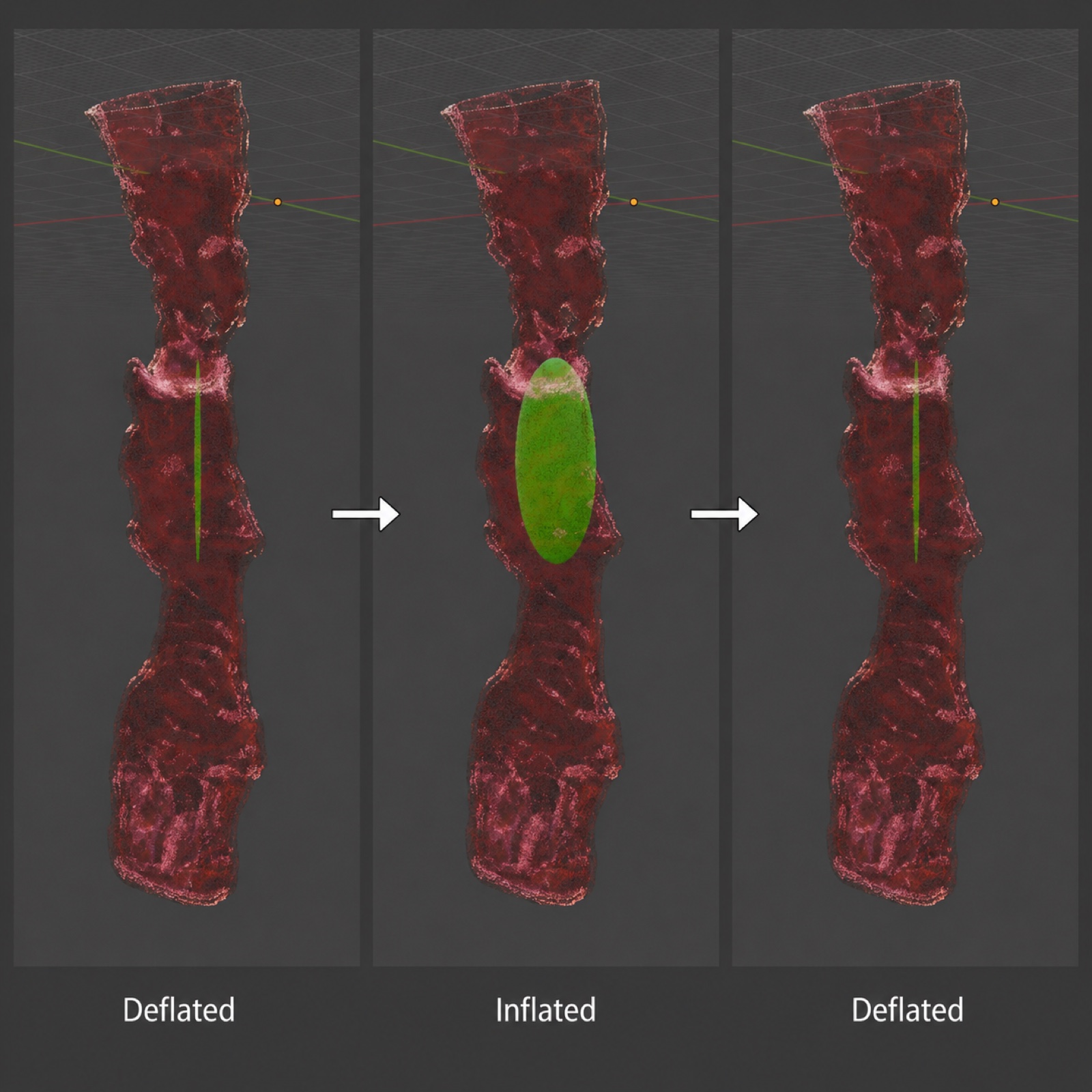 Three-stage Blender balloon dilation animation showing deflated, inflated, and deflated states